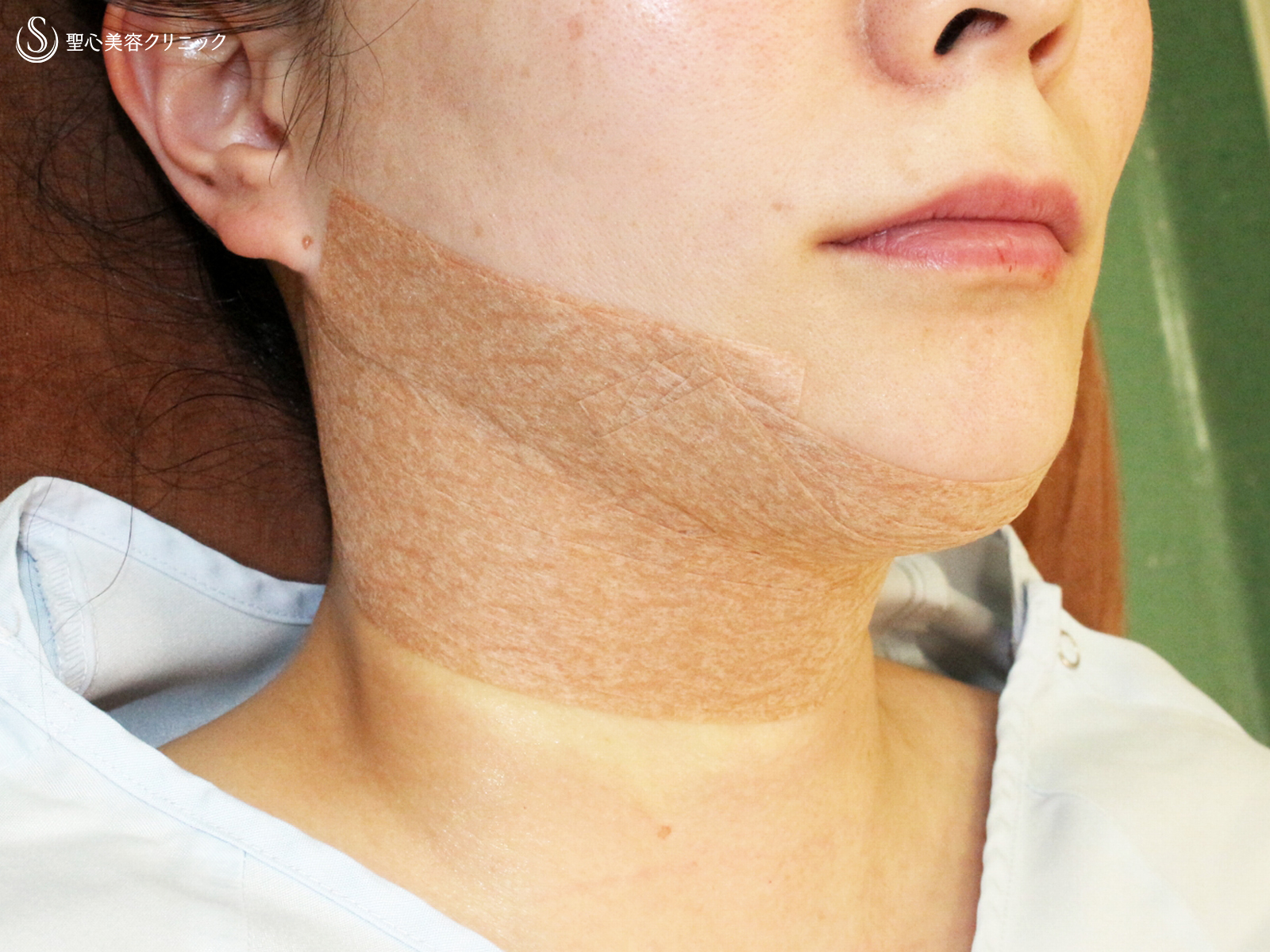 【30代女性・これだけで劇的変化】脂肪吸引注射 あご下（術直後〜1ヶ月後） Before 