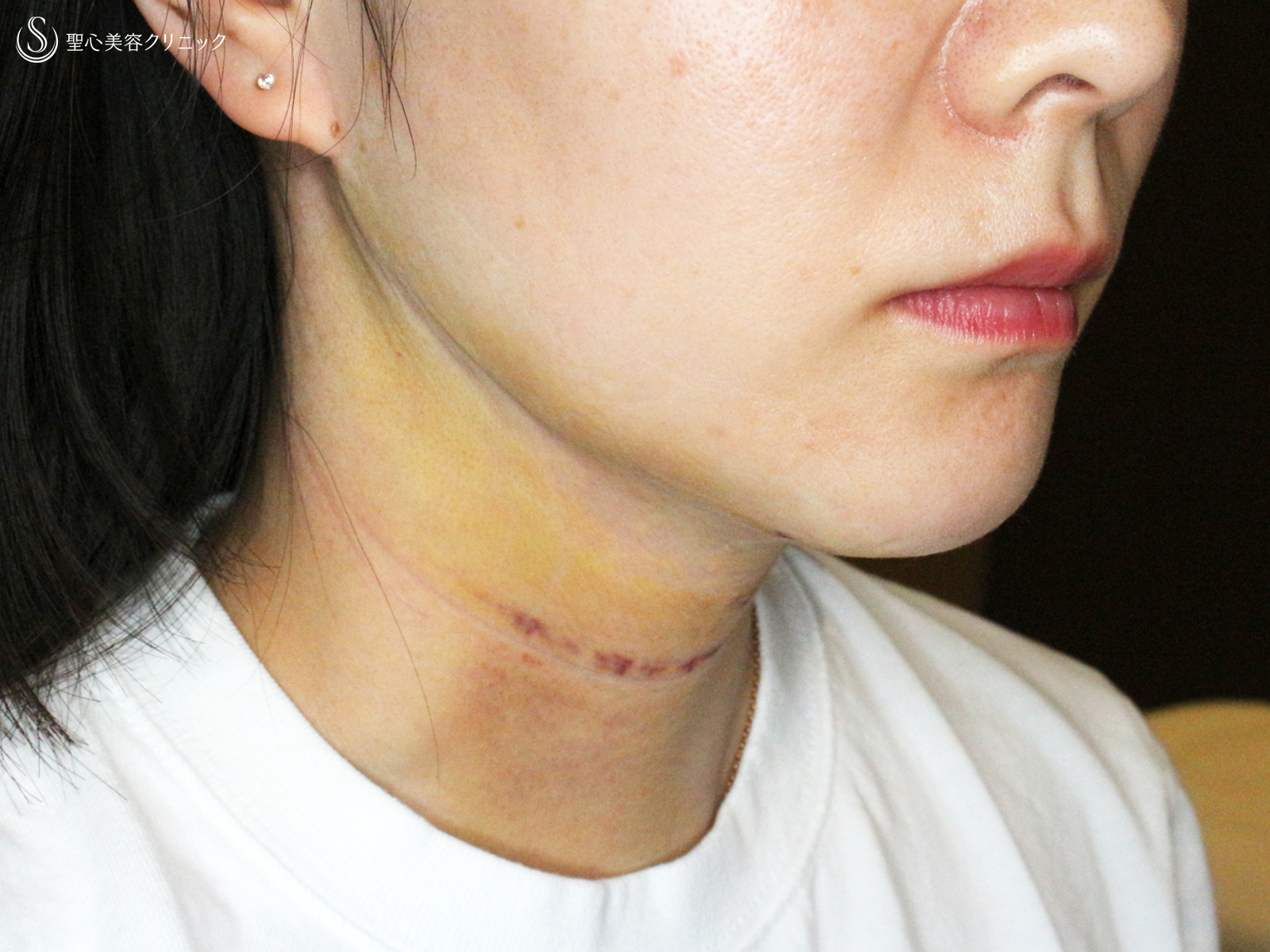 【30代女性・これだけで劇的変化】脂肪吸引注射 あご下（術直後〜1ヶ月後） After 