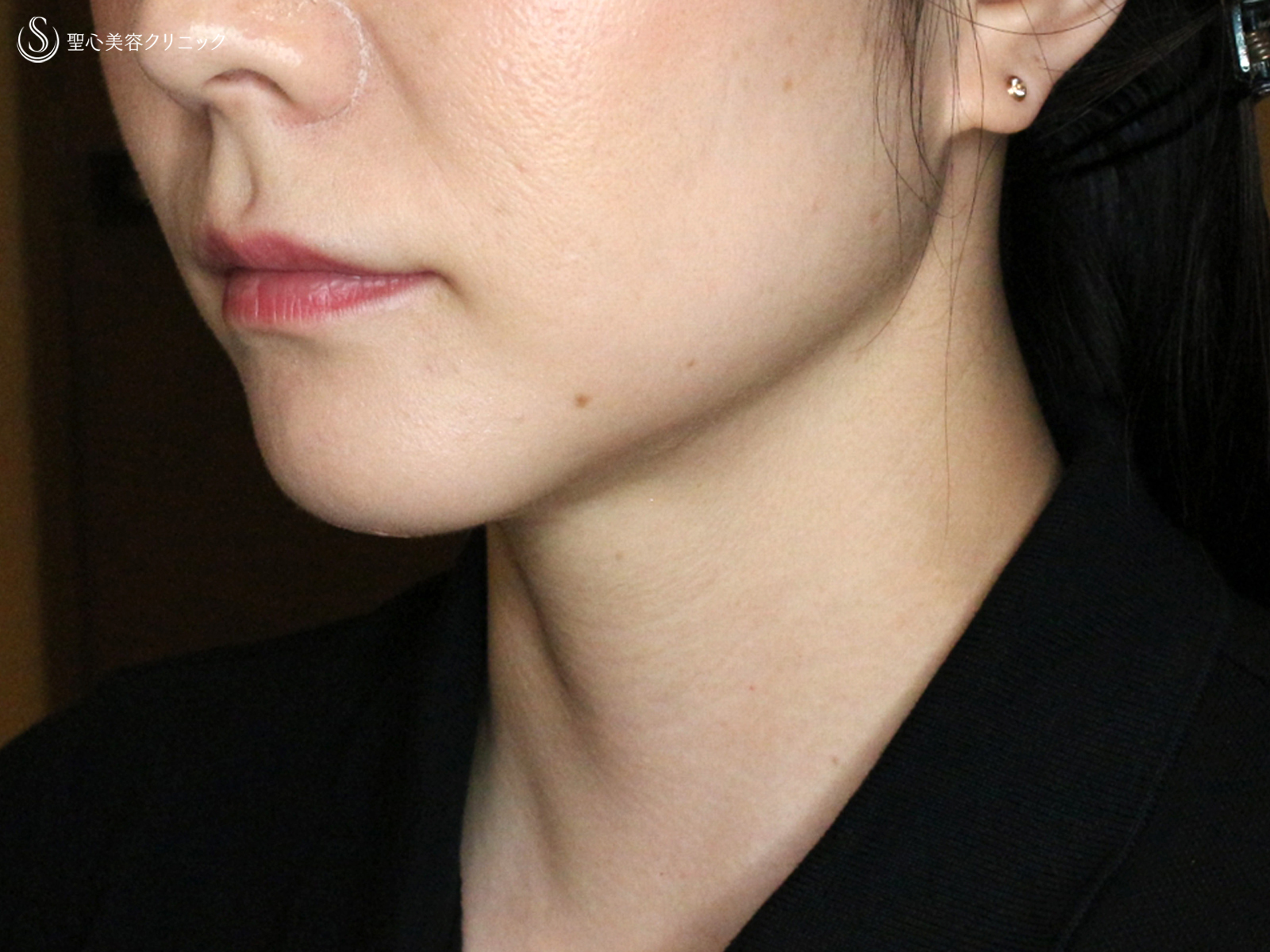 【30代女性・これだけで劇的変化】脂肪吸引注射 あご下（術直後〜1ヶ月後） After 
