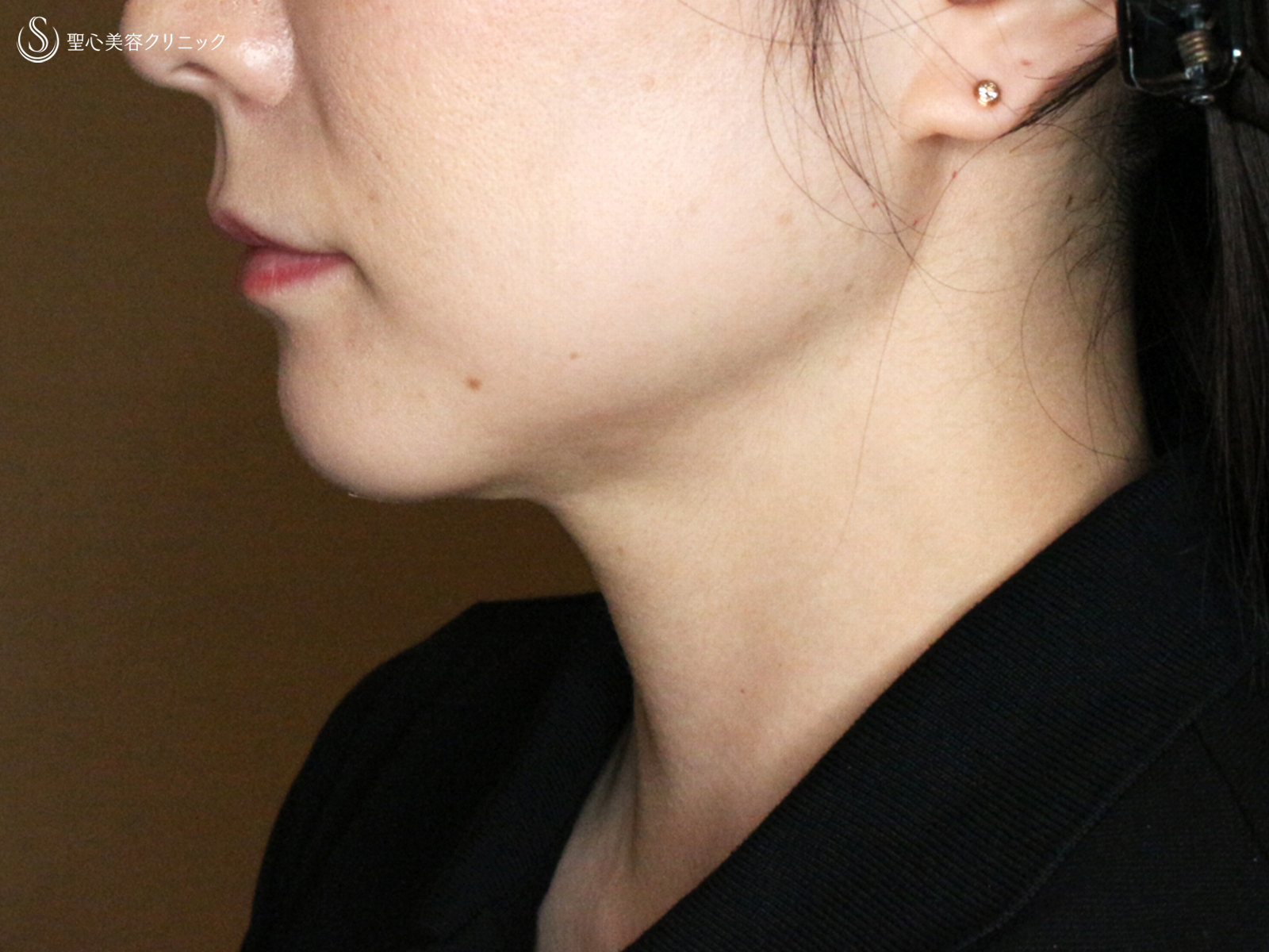 【30代女性・これだけで劇的変化】脂肪吸引注射 あご下（術直後〜1ヶ月後） After 