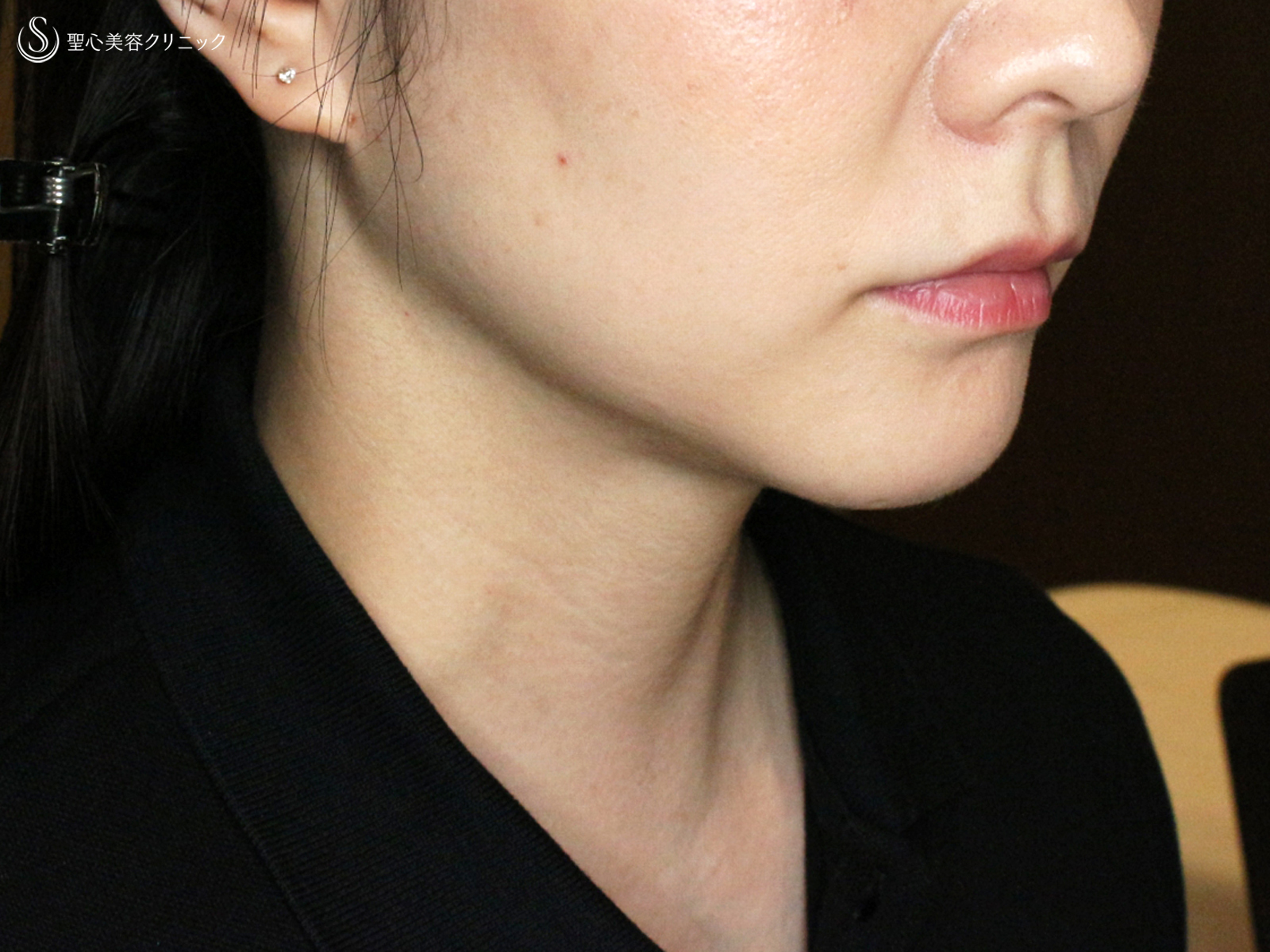 【30代女性・これだけで劇的変化】脂肪吸引注射 あご下（術直後〜1ヶ月後） After 
