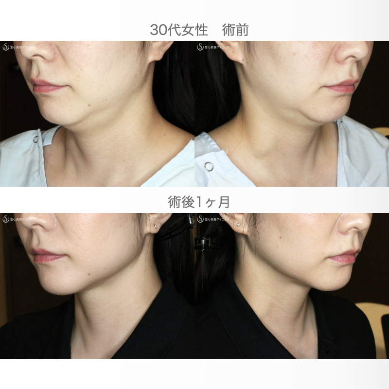 【30代女性・これだけで劇的変化】脂肪吸引注射 あご下（術直後〜1ヶ月後） After 