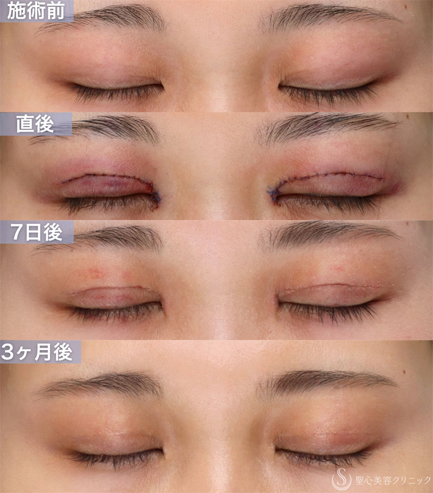【20代女性・眠たそうな印象から、明るい目元へ】眼瞼下垂手術＋目上切開（直後～3ヶ月後） After 