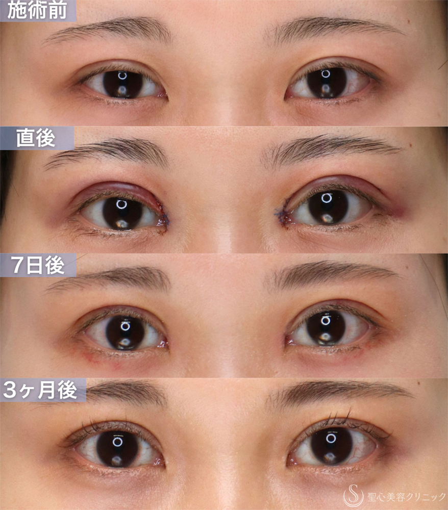 【20代女性・眠たそうな印象から、明るい目元へ】眼瞼下垂手術＋目上切開（直後～3ヶ月後） After 