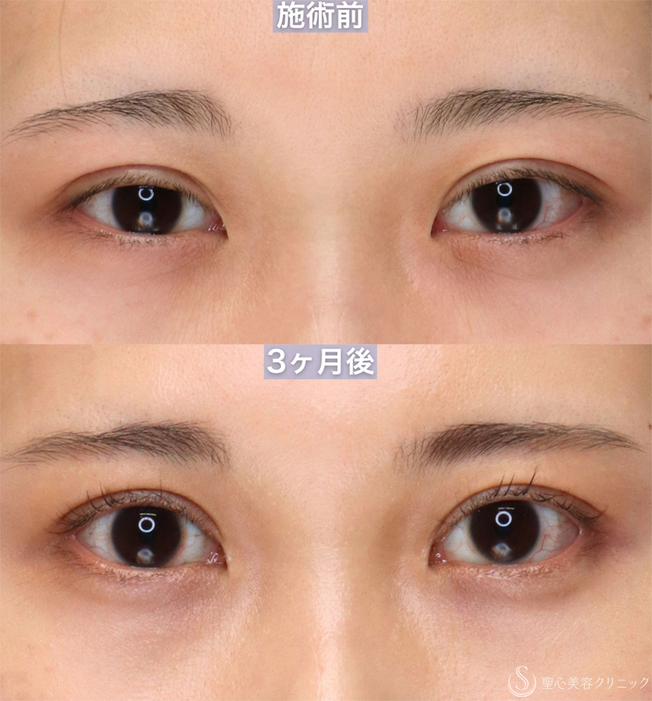 【20代女性・眠たそうな印象から、明るい目元へ】眼瞼下垂手術＋目上切開（直後～3ヶ月後） After 