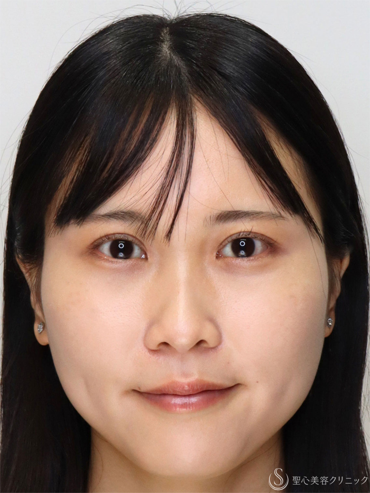 【20代女性・眠たそうな印象から、明るい目元へ】眼瞼下垂手術＋目上切開（直後～3ヶ月後） After 