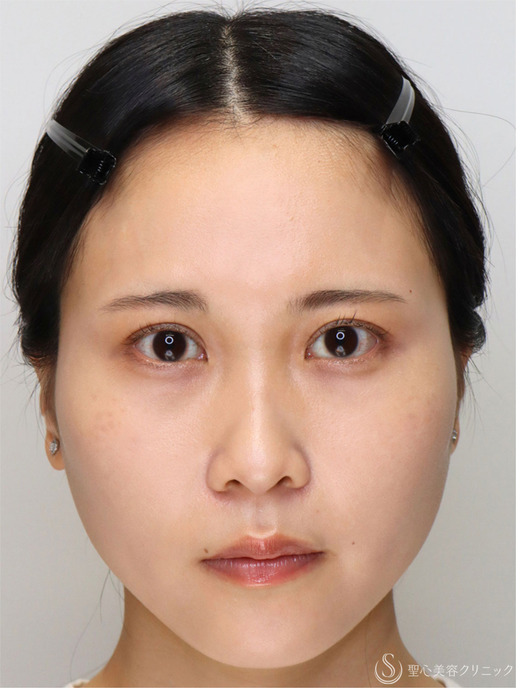 【20代女性・眠たそうな印象から、明るい目元へ】眼瞼下垂手術＋目上切開（直後～3ヶ月後） After 