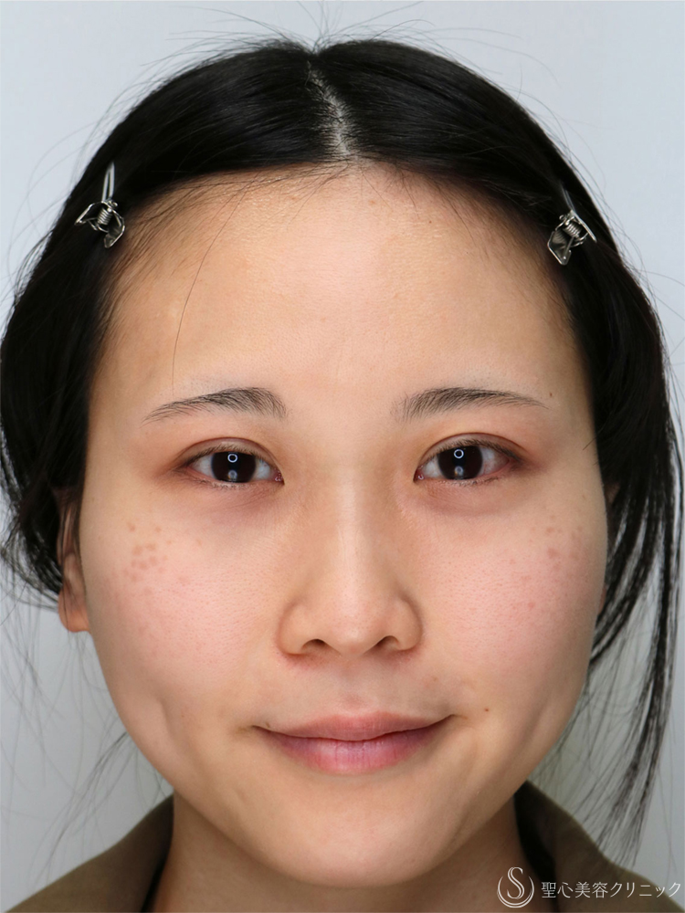 【20代女性・眠たそうな印象から、明るい目元へ】眼瞼下垂手術＋目上切開（直後～3ヶ月後） Before 