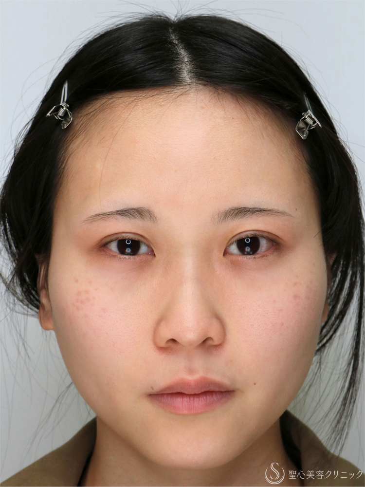【20代女性・眠たそうな印象から、明るい目元へ】眼瞼下垂手術＋目上切開（直後～3ヶ月後） Before 