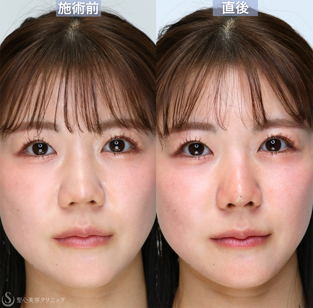 【20代女性・切らずに、美しい鼻のシルエットへ】鼻中隔ヒアルロン酸（直後） After 