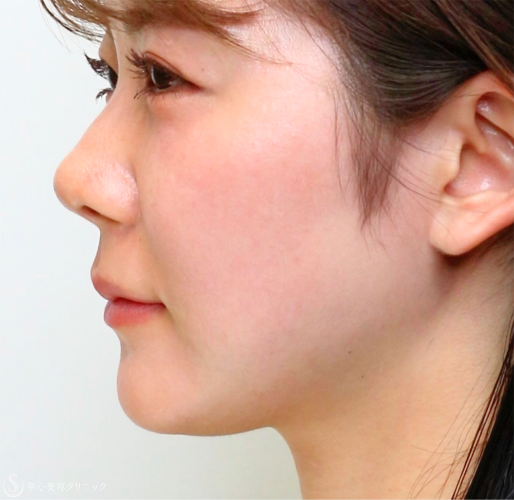 【20代女性・切らずに、美しい鼻のシルエットへ】鼻中隔ヒアルロン酸（直後） After 