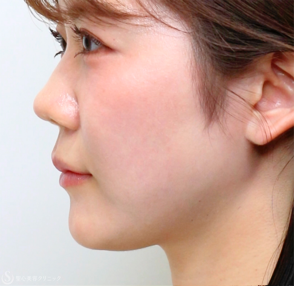 【20代女性・切らずに、美しい鼻のシルエットへ】鼻中隔ヒアルロン酸（直後） Before 