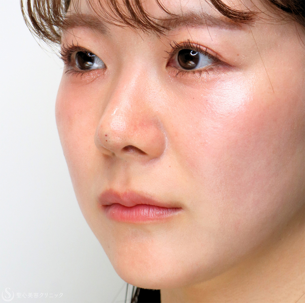 【20代女性・切らずに、美しい鼻のシルエットへ】鼻中隔ヒアルロン酸（直後） After 