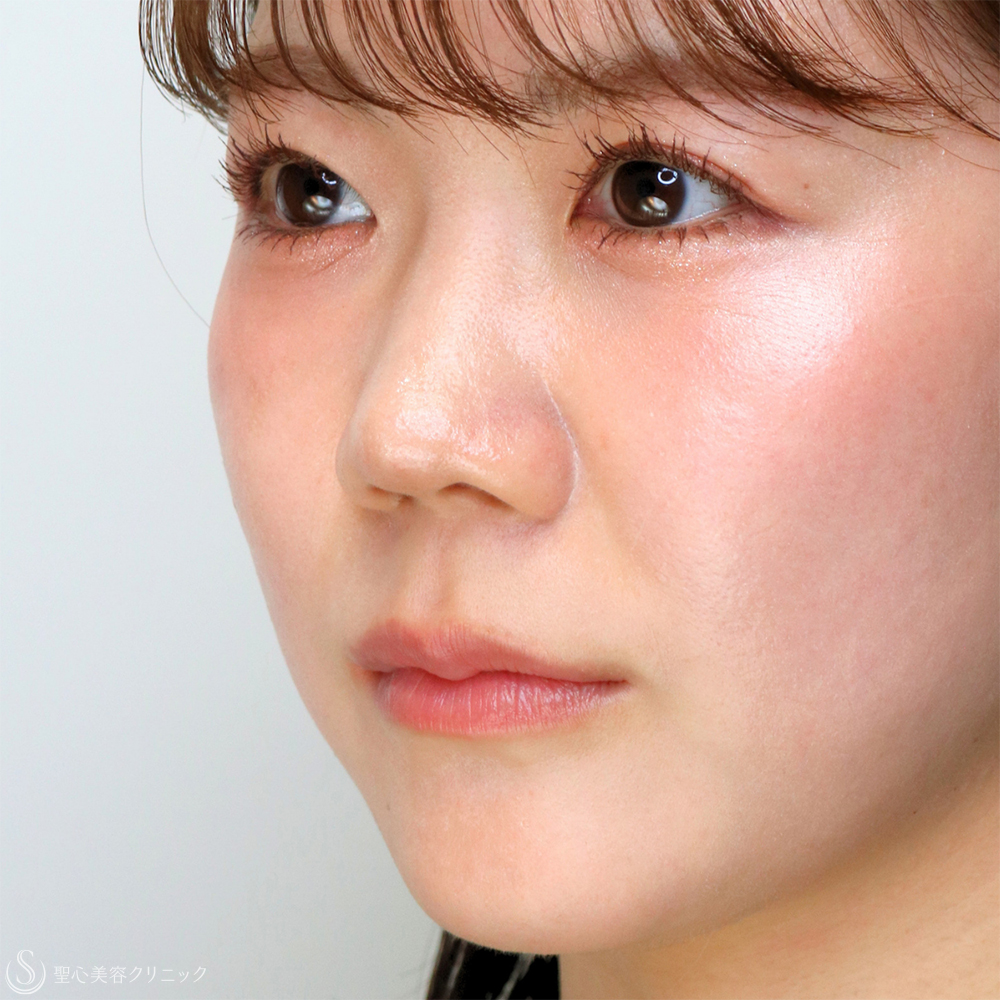 【20代女性・切らずに、美しい鼻のシルエットへ】鼻中隔ヒアルロン酸（直後） Before 