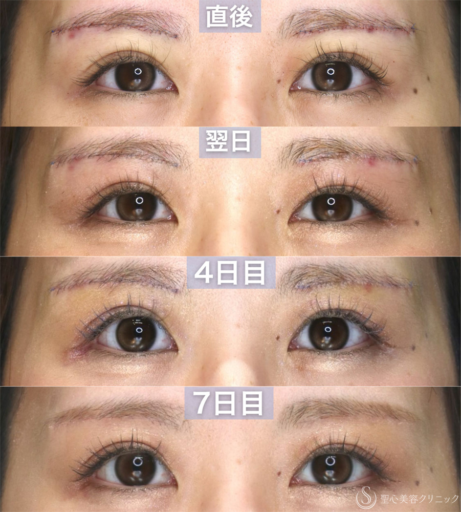 【30代女性・眉下切開の傷跡について】眉下切開（直後〜7ヶ月後） After 