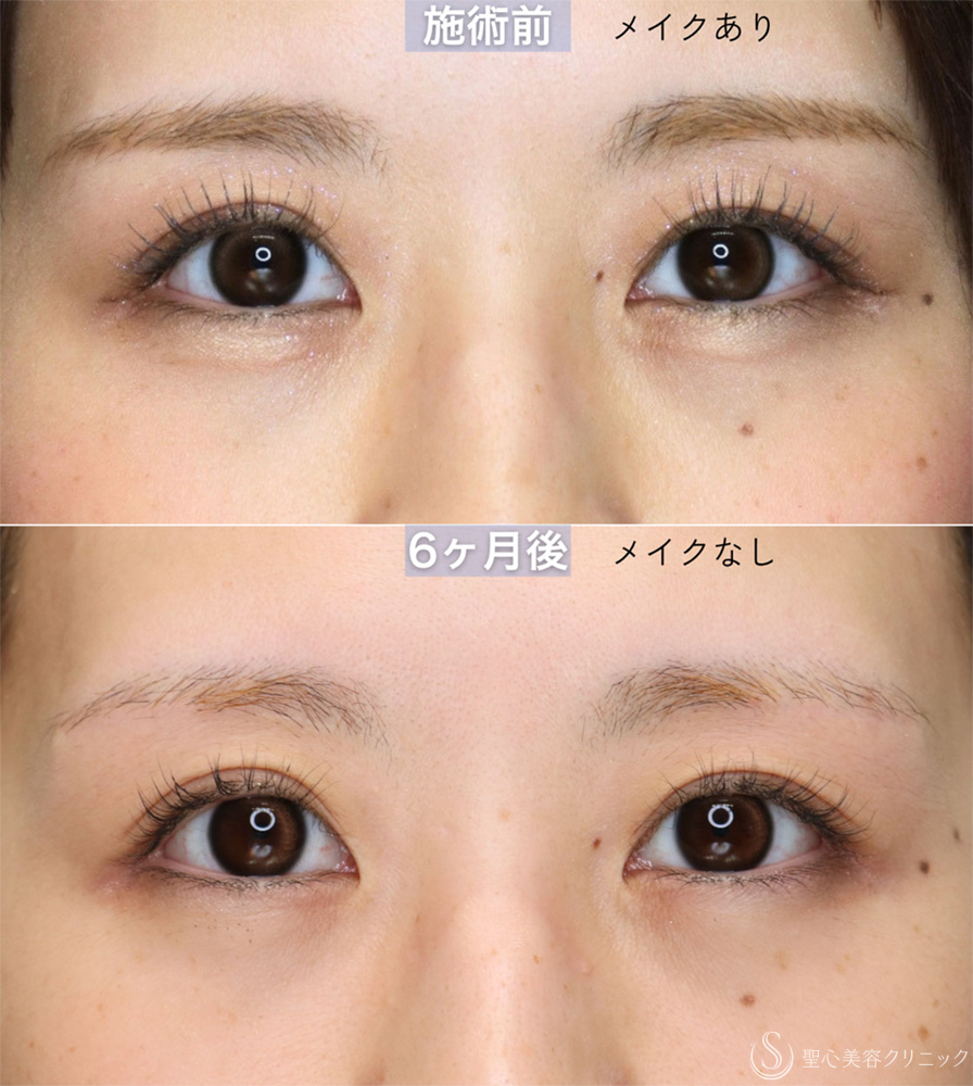 【30代女性・眉下切開の傷跡について】眉下切開（直後〜7ヶ月後） After 
