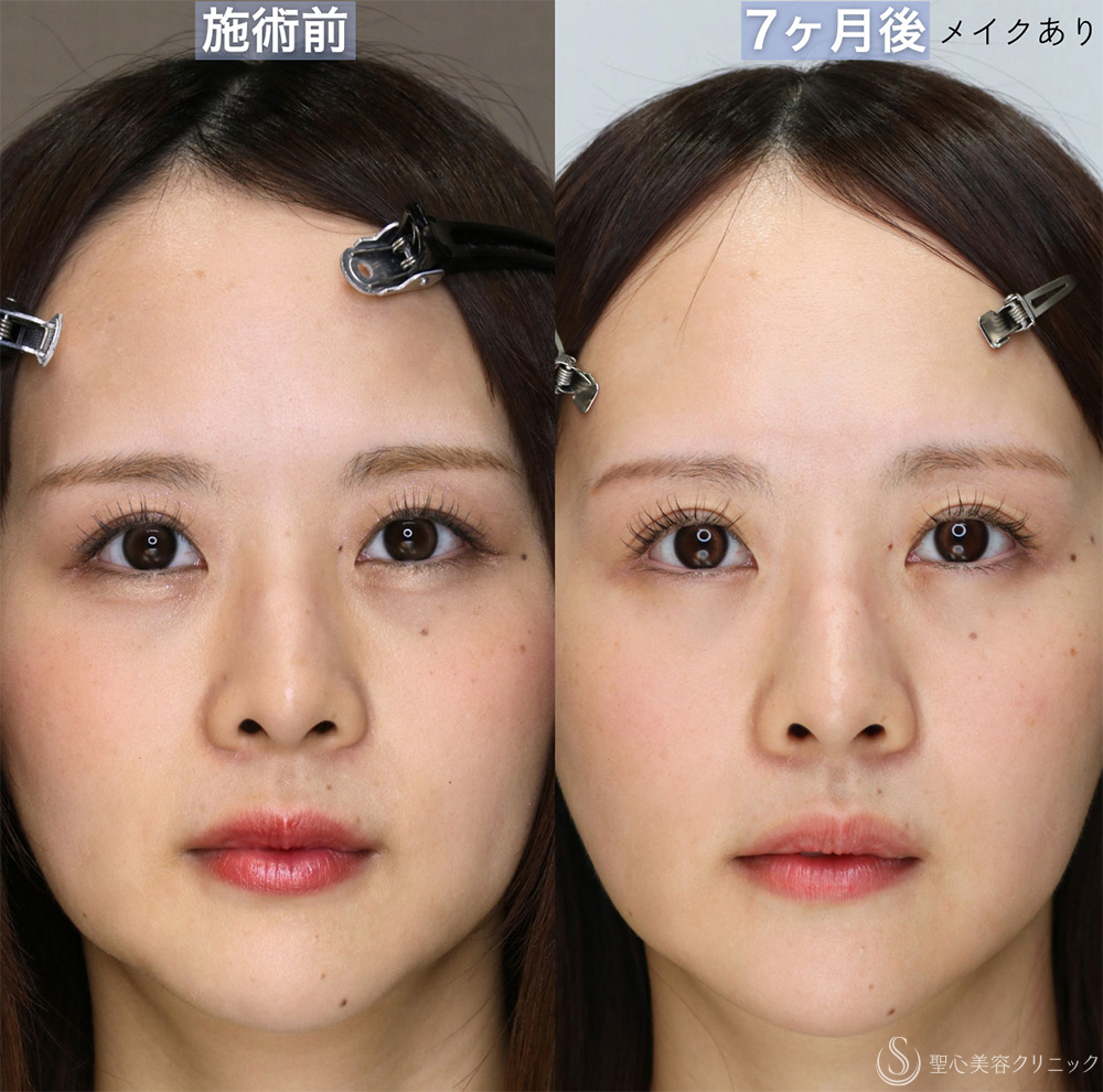 【30代女性・眉下切開の傷跡について】眉下切開（直後〜7ヶ月後） After 