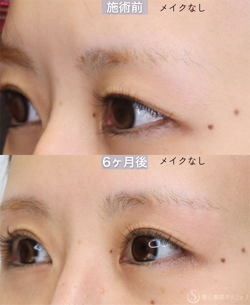 【30代女性・眉下切開の傷跡について】眉下切開（直後〜7ヶ月後） After 