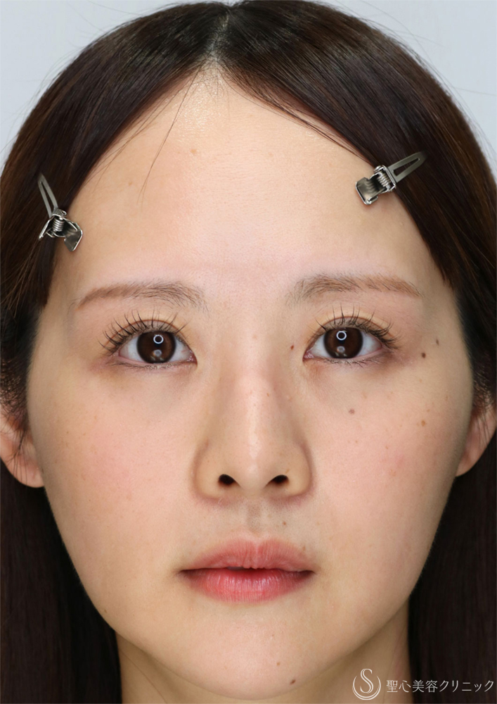 【30代女性・眉下切開の傷跡について】眉下切開（直後〜7ヶ月後） After 