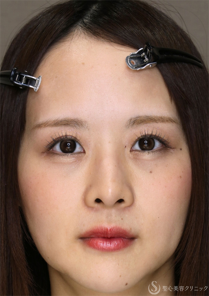 【30代女性・眉下切開の傷跡について】眉下切開（直後〜7ヶ月後） Before 