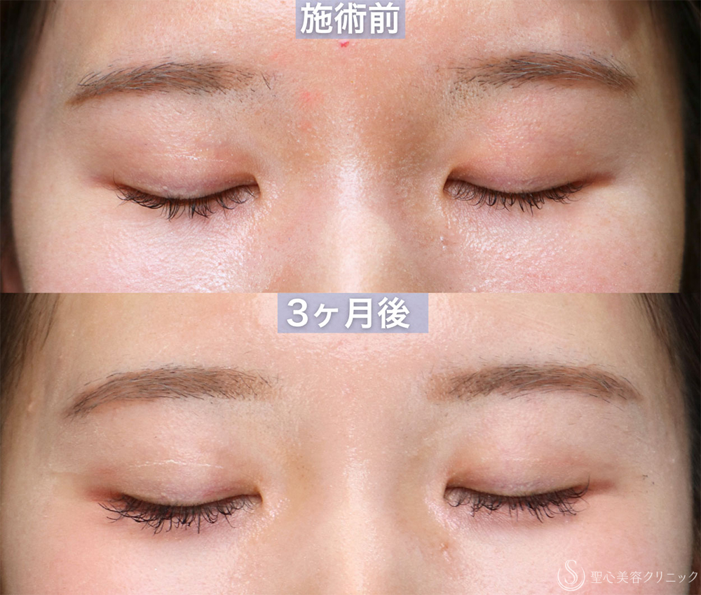 【20代女性・蒙古襞のラインを整え、自然な平行〜mix型二重へ】埋没法＋目上切開（3ヶ月後） After 