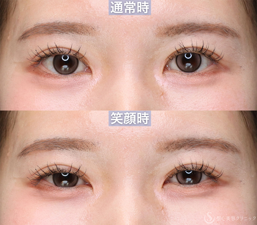 【20代女性・蒙古襞のラインを整え、自然な平行〜mix型二重へ】埋没法＋目上切開（3ヶ月後） After 