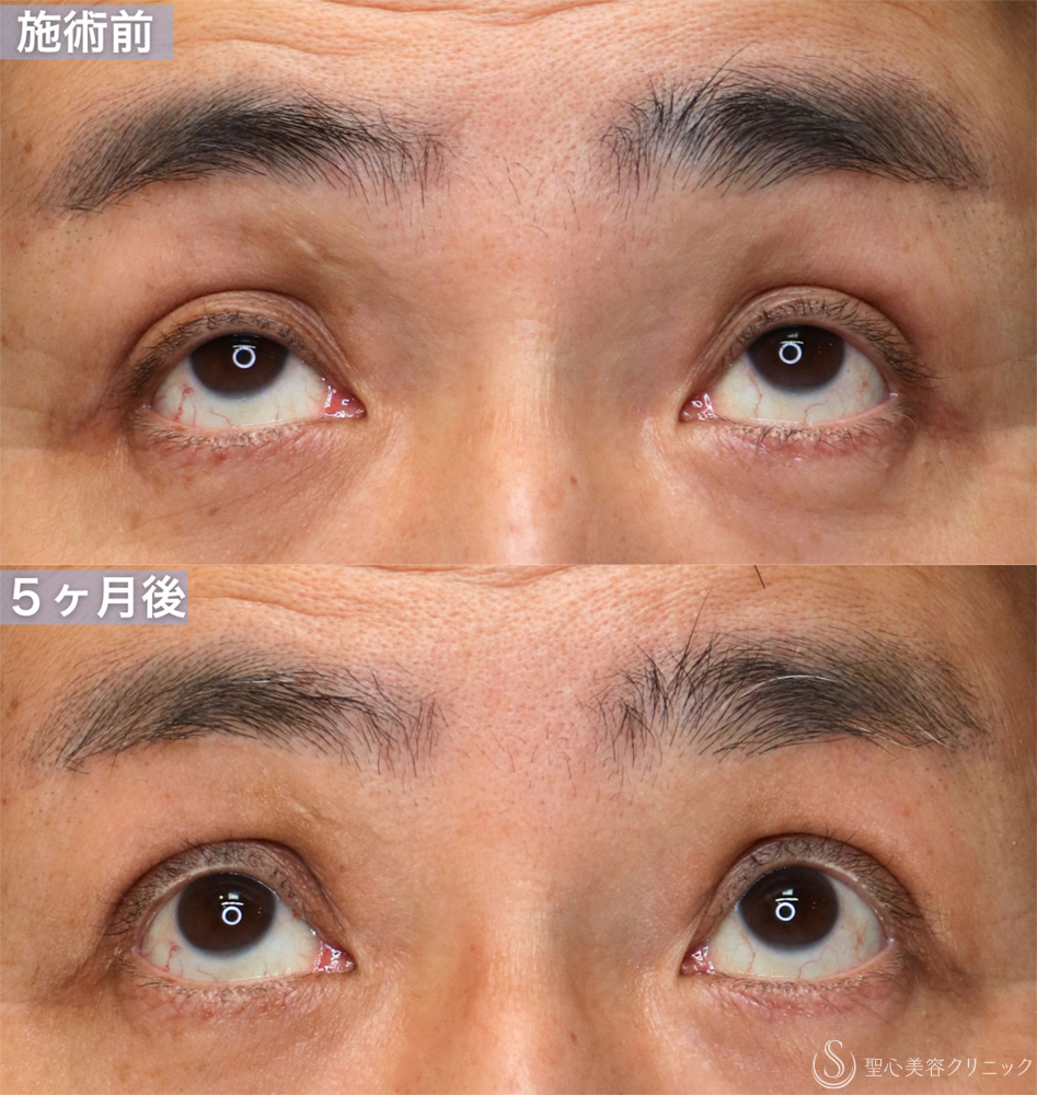 【60代男性・窪み目、目の開きを改善する】眼瞼下垂 腱膜縫縮法＋額ボトックス（5ヶ月後） After 
