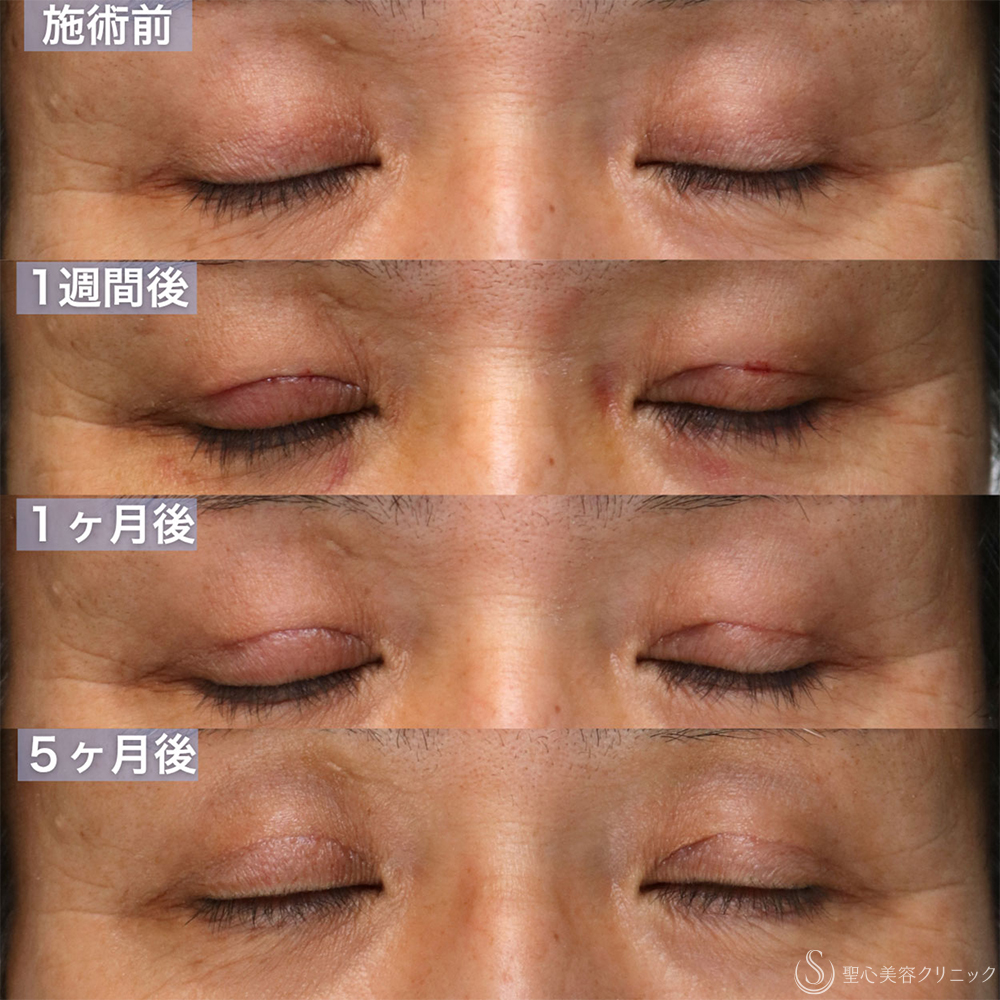 【60代男性・窪み目、目の開きを改善する】眼瞼下垂 腱膜縫縮法＋額ボトックス（5ヶ月後） After 