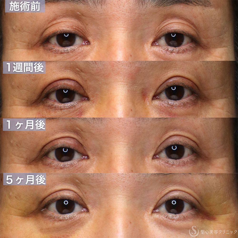 【60代男性・窪み目、目の開きを改善する】眼瞼下垂 腱膜縫縮法＋額ボトックス（5ヶ月後） After 