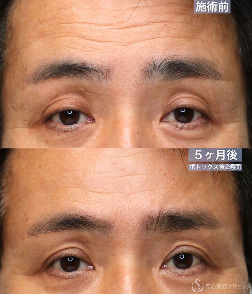 【60代男性・窪み目、目の開きを改善する】眼瞼下垂 腱膜縫縮法＋額ボトックス（5ヶ月後） After 