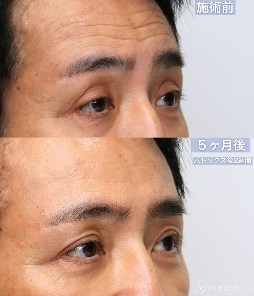 【60代男性・窪み目、目の開きを改善する】眼瞼下垂 腱膜縫縮法＋額ボトックス（5ヶ月後） Before 