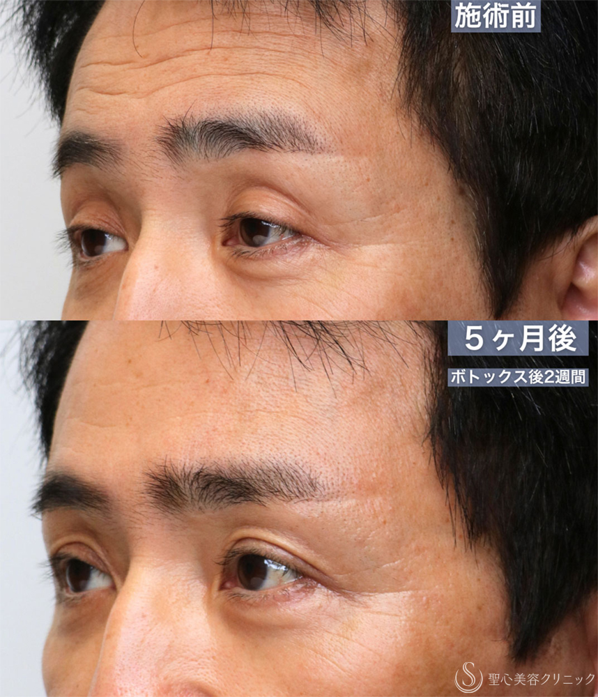 【60代男性・窪み目、目の開きを改善する】眼瞼下垂 腱膜縫縮法＋額ボトックス（5ヶ月後） Before 