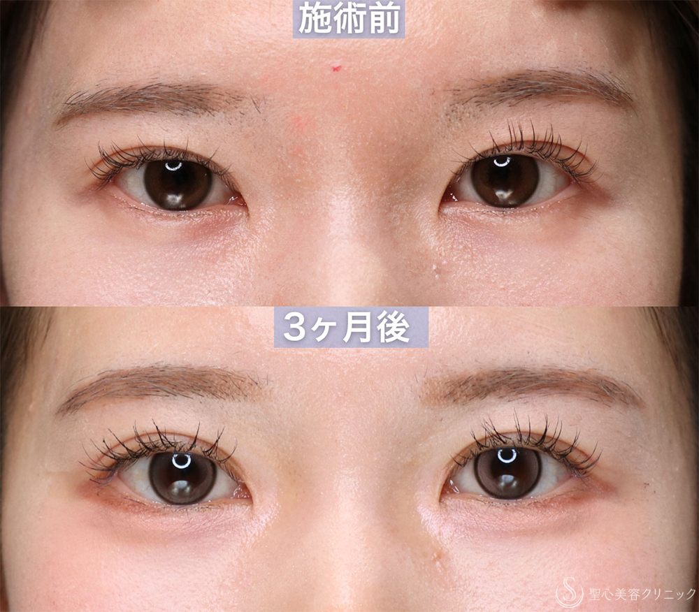 20代女性・蒙古襞のラインを整え、自然な平行〜mix型二重へ】埋没法＋