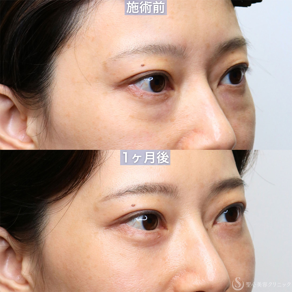 【30代女性・皮膚を切らずに、目のクマを改善させる】裏ハムラ法（直後〜1ヶ月後） Before 
