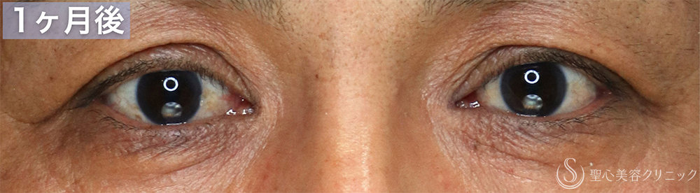 【40代男性・目の開きの左右差を改善する】眼瞼下垂手術（腱膜縫縮法・左目のみ）（直後〜1ヶ月後） After 