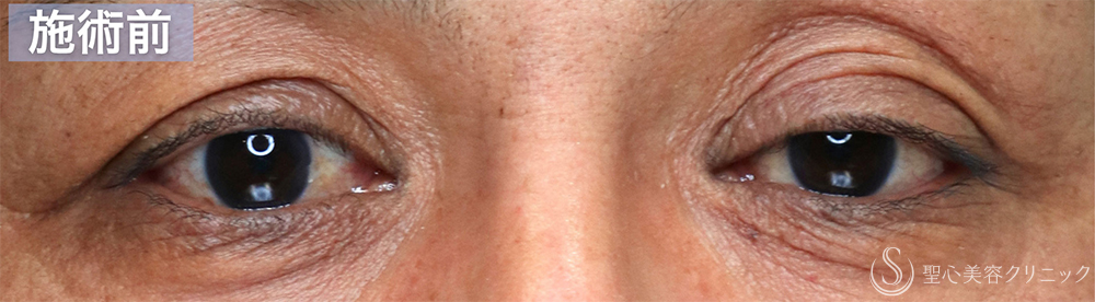 【40代男性・目の開きの左右差を改善する】眼瞼下垂手術（腱膜縫縮法・左目のみ）（直後〜1ヶ月後） Before 