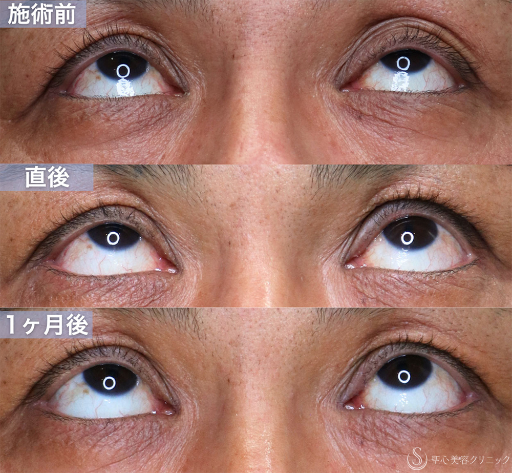 【40代男性・目の開きの左右差を改善する】眼瞼下垂手術（腱膜縫縮法・左目のみ）（直後〜1ヶ月後） After 