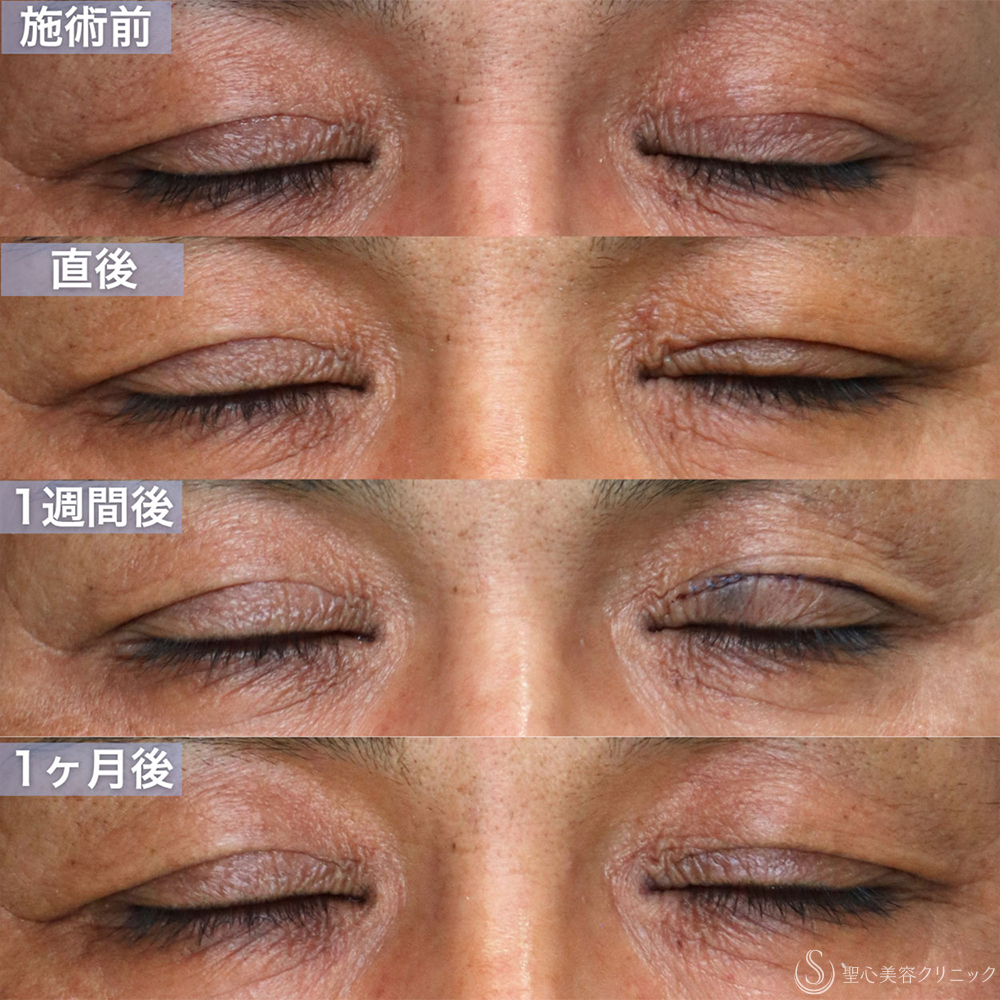 【40代男性・目の開きの左右差を改善する】眼瞼下垂手術（腱膜縫縮法・左目のみ）（直後〜1ヶ月後） After 