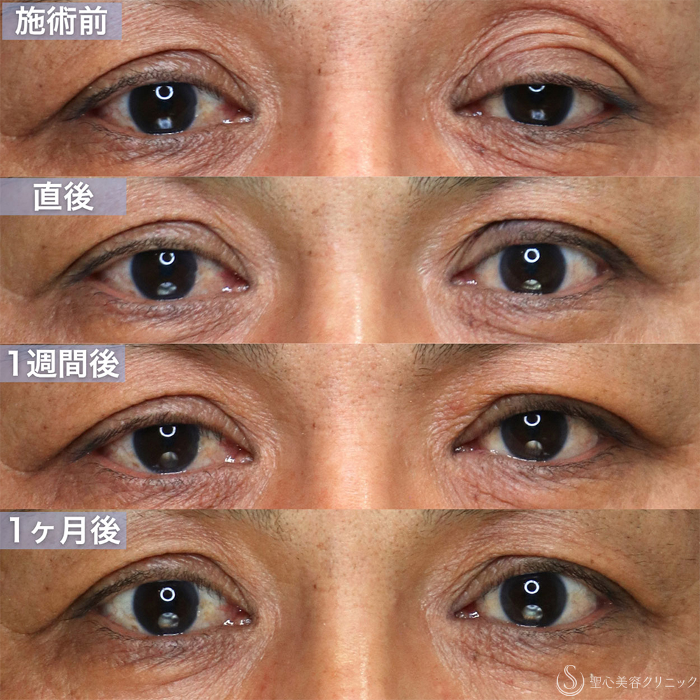 【40代男性・目の開きの左右差を改善する】眼瞼下垂手術（腱膜縫縮法・左目のみ）（直後〜1ヶ月後） After 