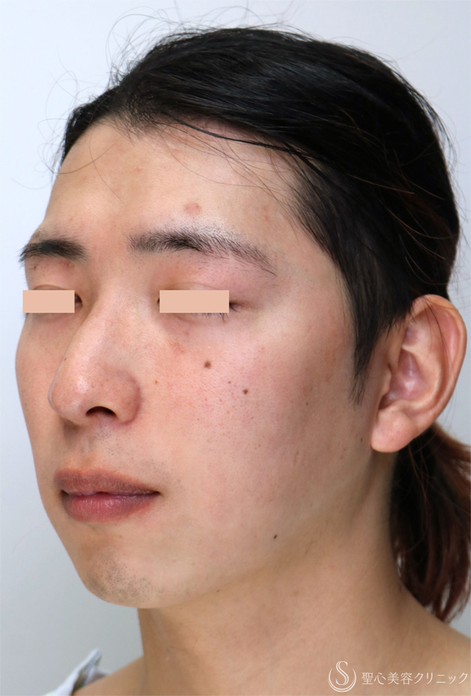 【20代男性・過度な主張のない、自然で美しい顎のライン】顎プロテーゼ手術（直後〜1ヶ月後） Before 
