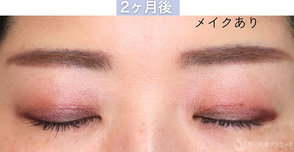 【30代女性・自然な二重を作成する】二重切開＋脱脂（1週間〜2ヶ月後） After 