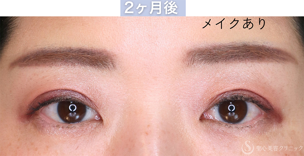 【30代女性・自然な二重を作成する】二重切開＋脱脂（1週間〜2ヶ月後） After 