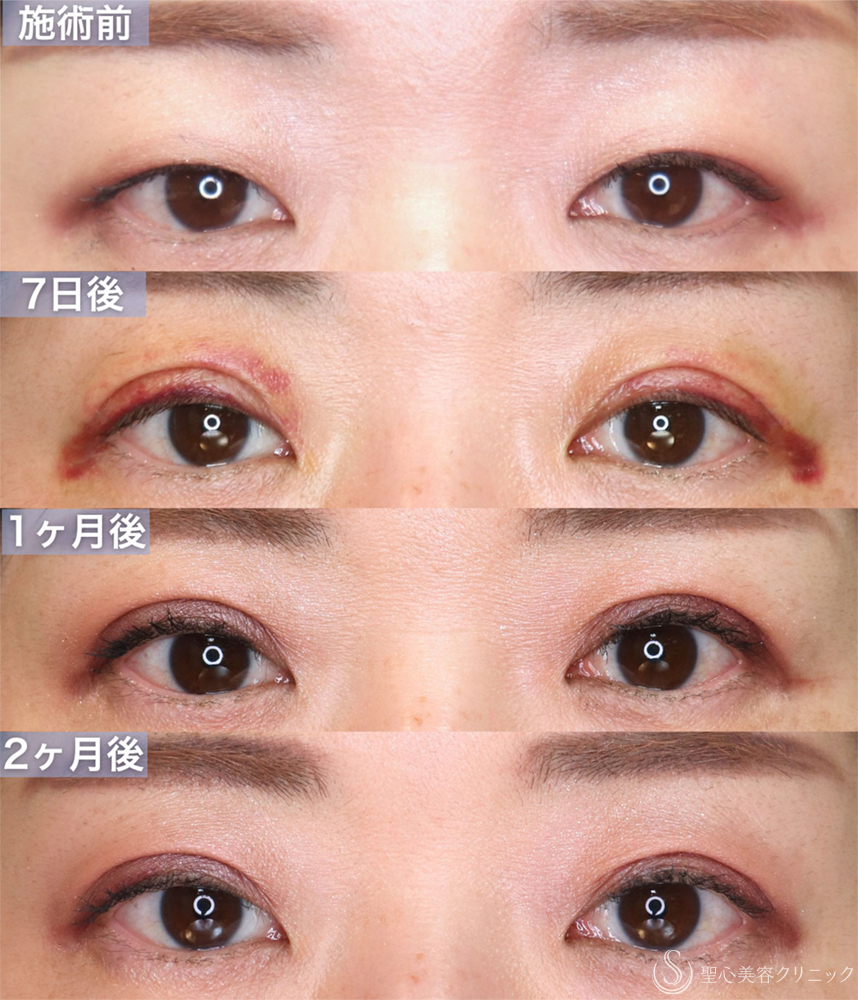 【30代女性・自然な二重を作成する】二重切開＋脱脂（1週間〜2ヶ月後） After 