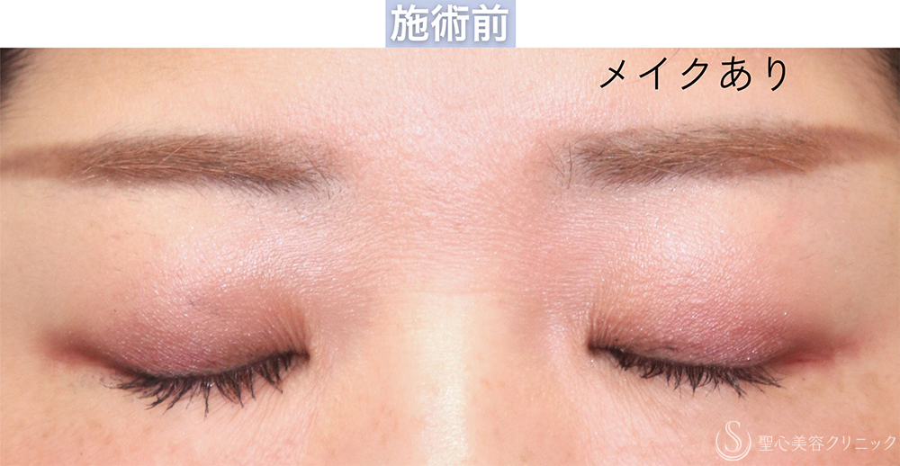 【30代女性・自然な二重を作成する】二重切開＋脱脂（1週間〜2ヶ月後） Before 