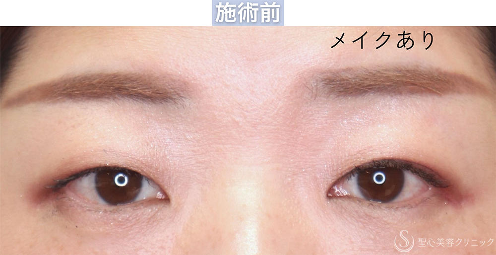 【30代女性・自然な二重を作成する】二重切開＋脱脂（1週間〜2ヶ月後） Before 