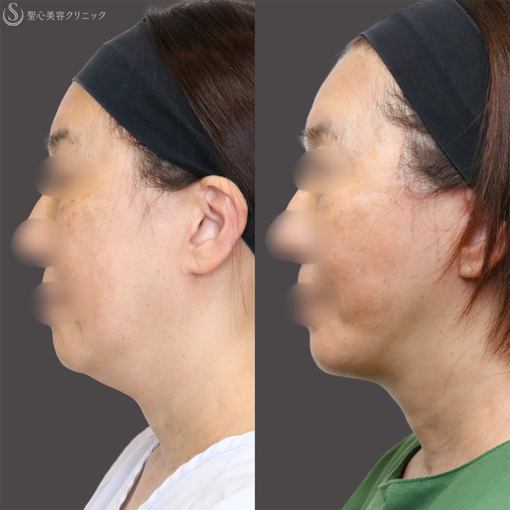 【60代女性・フェイスラインをすっきり】フェイスリフト＋脂肪吸引（頬＋顎下）＋リガメント処理（3ヶ月後） After 名古屋+フェイスリフト　たるみ　脂肪吸引　若返り