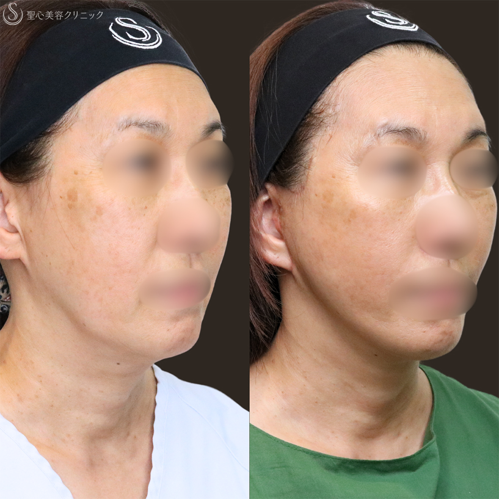 【60代女性・フェイスラインをすっきり】フェイスリフト＋脂肪吸引（頬＋顎下）＋リガメント処理（3ヶ月後） After 名古屋+フェイスリフト　たるみ　脂肪吸引　若返り