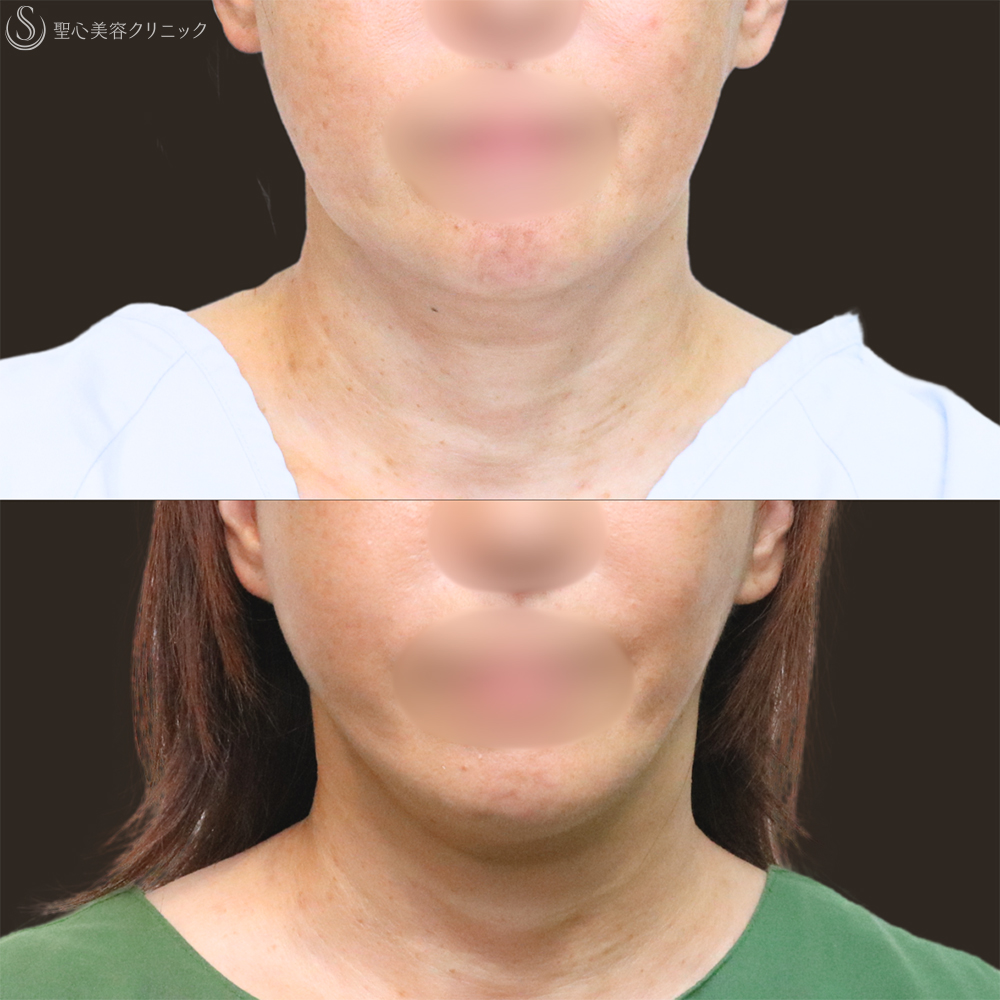 【60代女性・フェイスラインをすっきり】フェイスリフト＋脂肪吸引（頬＋顎下）＋リガメント処理（3ヶ月後） After 名古屋+フェイスリフト　たるみ　脂肪吸引　若返り