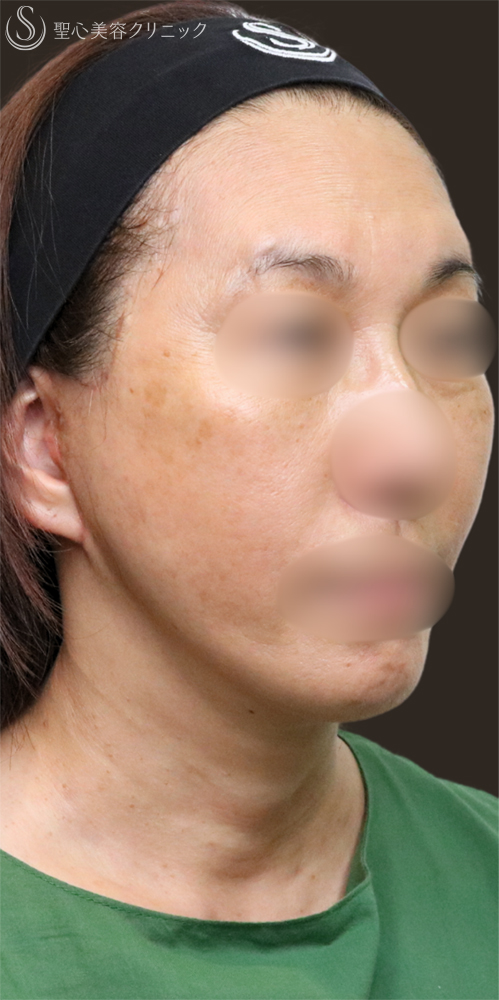【60代女性・フェイスラインをすっきり】フェイスリフト＋脂肪吸引（頬＋顎下）＋リガメント処理（3ヶ月後） After 名古屋+フェイスリフト　たるみ　脂肪吸引　若返り