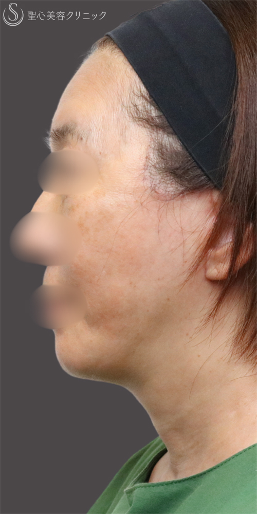 【60代女性・フェイスラインをすっきり】フェイスリフト＋脂肪吸引（頬＋顎下）＋リガメント処理（3ヶ月後） After 名古屋+フェイスリフト　たるみ　脂肪吸引　若返り